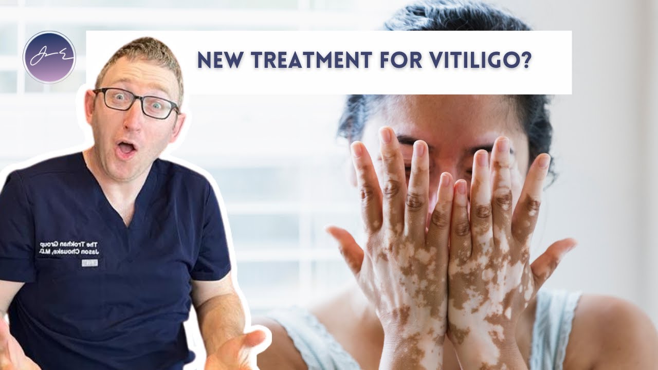 Is this the new treatment for Vitiligo?