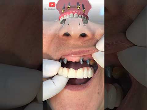 Incredible transformation! ❤ dental implants