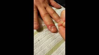 Lance or drain ingrown nail or infected cuticle