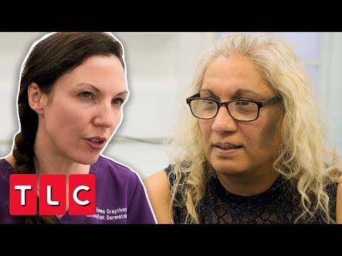 Diabetes Is The Reason For This Woman's Dark Patches On Her Face | Bad Skin Clinic