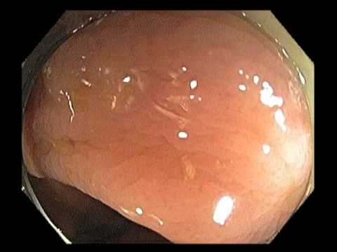 Ascending Colon - Failed Resection of Large Polyp