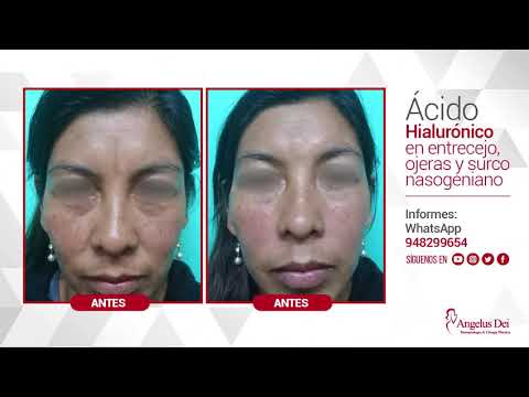 Antes y Después – Ácido Hialurónico