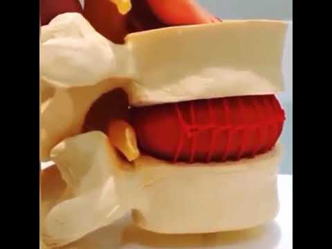 Hernia discal y fisioterapia