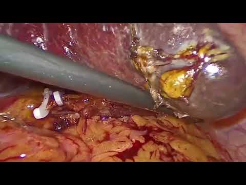 Laparoscopic Splenectomy – Part 1