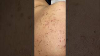 Blackhead removal #acne  #blackheads