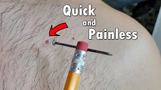 How to Remove Red Skin Dots at Home \\ Cherry Angioma Removal