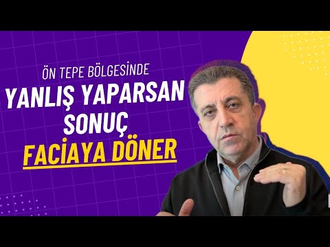 Saç Ekiminde Ön Saç Çizgisinin Önemi - Dr. Hamid AYDIN