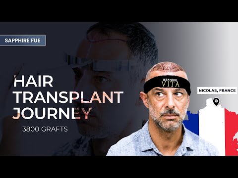 My Experience with Istanbul Vita from France | Hair Transplant in Istanbul / Turkey