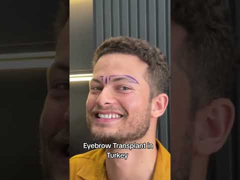 Eyebrow Transplant Transplant in Turkey | Eyebrow Transplant in Turkey  #eyebrowtransplant