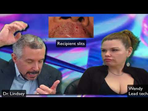 Mustache FUE update in Washington DC by Dr. Lindsey | McLean | Virginia | VA | MD thumbnail