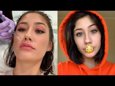 Getting LIP FILLERS for the first time!! *BOYFRIENDS REACTION*