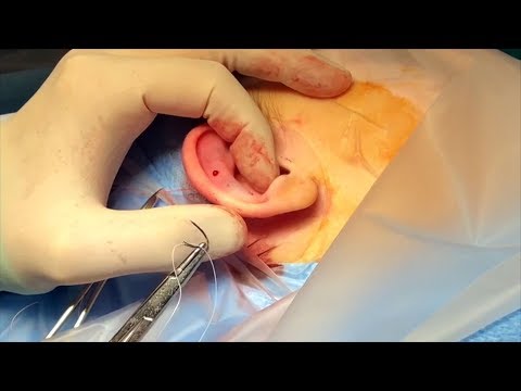 download lagu mp3 mp4 Ear Reshaping Sydney, download lagu Ear Reshaping Sydney gratis, unduh video klip Ear Reshaping Sydney