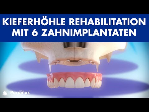 Kieferhöhle Rehabilitation mit 6 Zahnimplantaten ©