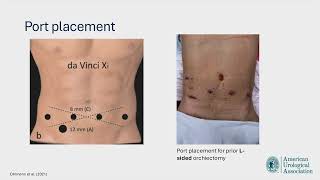 Core Videos (2024): Minimally-Invasive Surgical Approach to RPLND for Testis Cancer