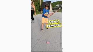 How Canadian kids remove teeth