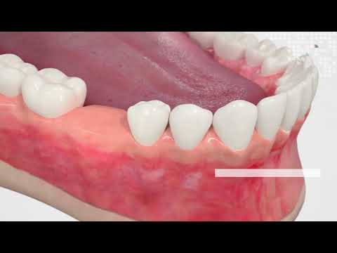 ZimVie TSX Implant from Zimmer Dental Tradition