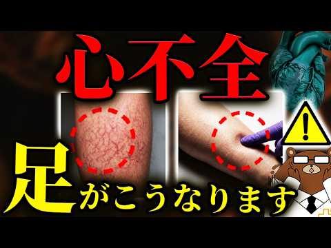 【超意外な初期症状】放置厳禁！知らないと後悔する心不全。まさかの「足」の危険サイン。靴下の跡.色.浮腫.意外な兆候とは？日本で急増している心不全の最新の対策「心臓リハビリ」とは？医師が徹底解説。