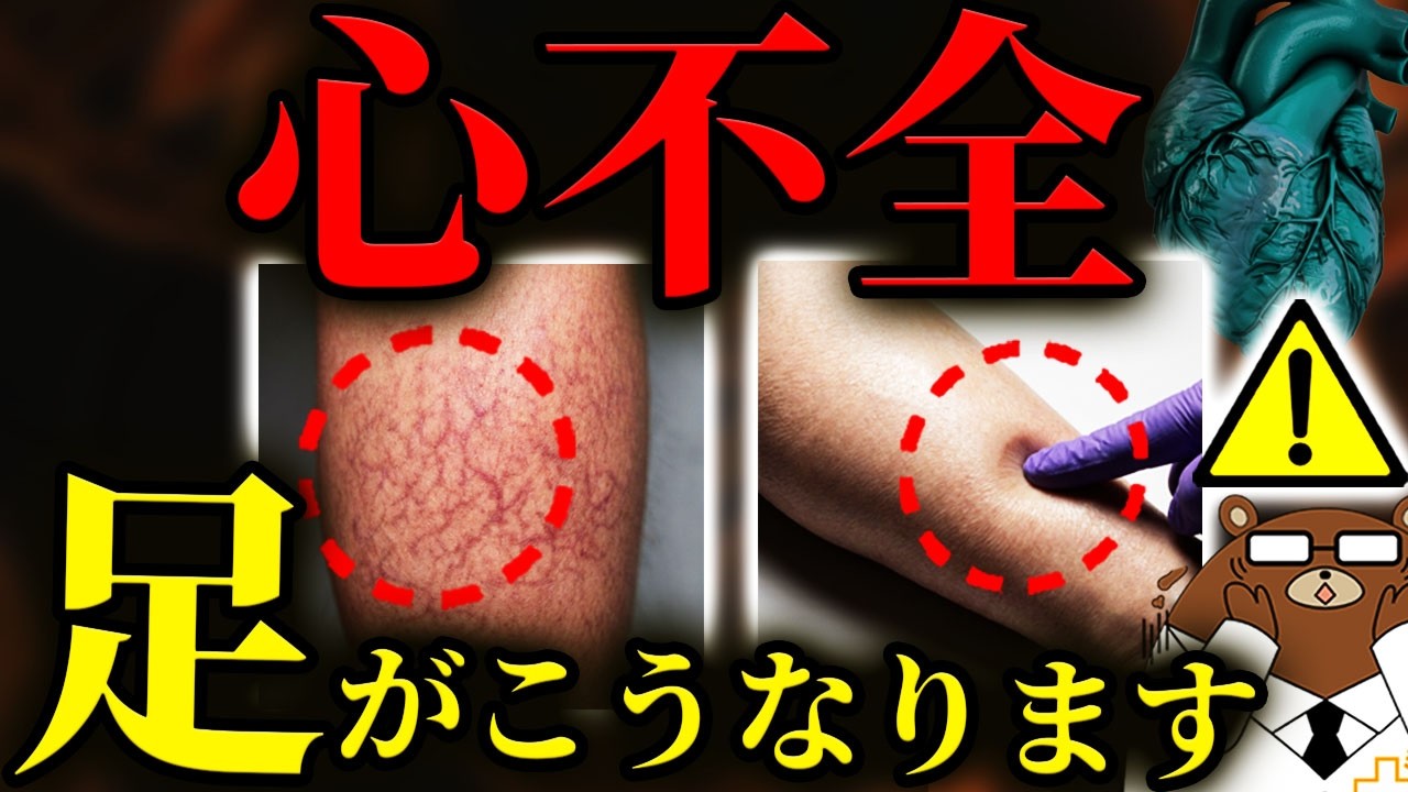 【超意外な初期症状】放置厳禁！知らないと後悔する心不全。まさかの「足」の危険サイン。靴下の跡.色.浮腫.意外な兆候とは？日本で急増している心不全の最新の対策「心臓リハビリ」とは？医師が徹底解説。