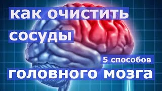 Как очистить сосуды головного мозга Как очистить сосуды головного мозга