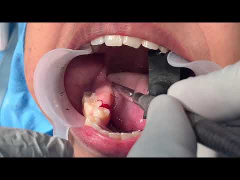 Exostosis Or Lower Jaw Bony Spur Excision Under Local Anesthesia