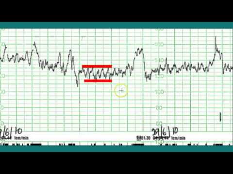 Ctg interpretation - Normal CTG