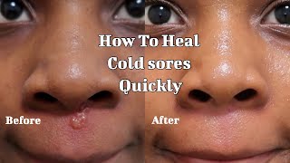 How to heal Cold sores quickly - Fast recovery + realistic way to treat breakouts (Baby powder)