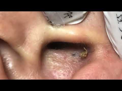 Massive Ear Blackhead Removal