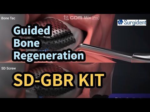 GBR System Surgident