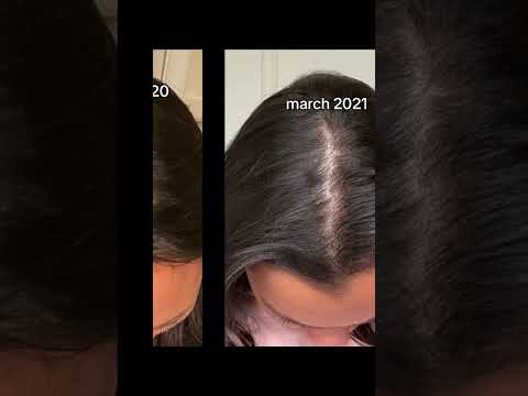 my hair loss journey- stress hair loss recovery