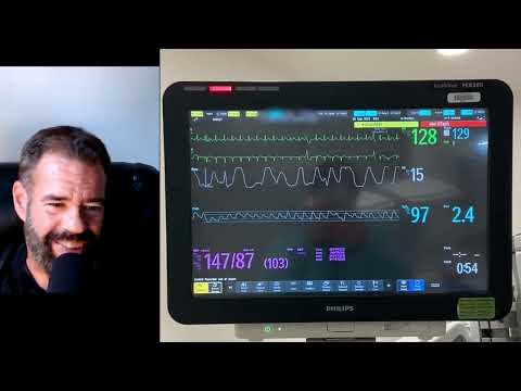 My heart rhythm had them stumped for hours! After 677 days my AFIB strikes back! Or something else?