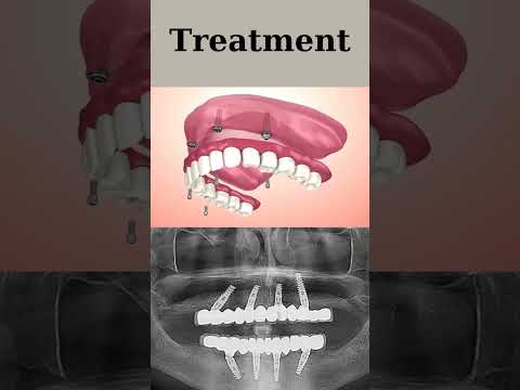 All-on-4 Dental Implants: A Complete Guide to Smile Restoration