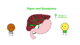 Choledocholithiasis Unraveled: EVERYTHING you NEED TO KNOW