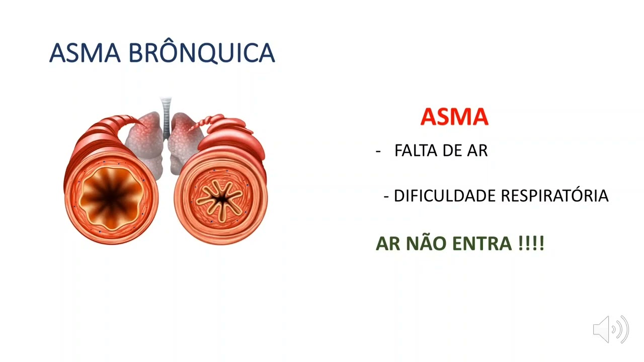 Asma, Bronquite e Bronquiolite - Quais são as diferenças?