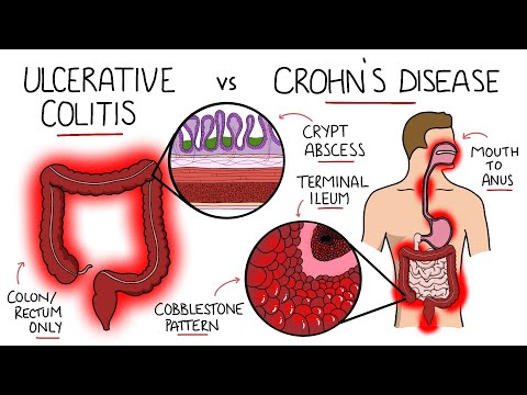 Inflammatory Bowel Disease - Ulcerative Colitis v Crohn's Disease (With Histology & Manifestations)