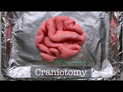 Cirugía de plastilina: craneotomía y extirpación de meningioma (tumor cerebral).