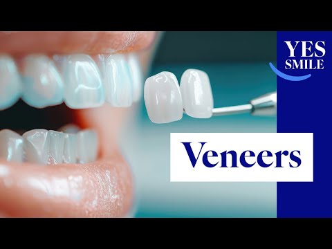 Veneer Behandlung erklärt: Alles, was Sie wissen müssen I YesSmile