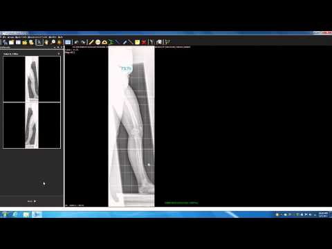 TraumaCad Deformity Course Part 2B - Deformity Correction