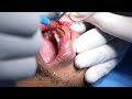 Cosmetic lip reduction surgery - Dr. Sunil Richardson