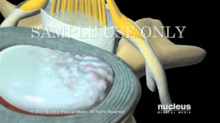 Inyección epidural de esteroides