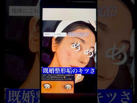 【朗報】三の上ユアを職業差◯した既婚整形垢のオバサン、大炎上する〜小鼻縮小の土手再建