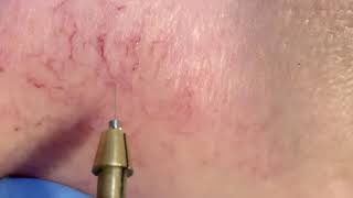 Facial red vein removal demo - super quick and easy with diathermy
