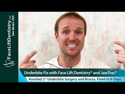 Underbite and Large Jaw Fix with Face Lift Dentistry®, 8-Days