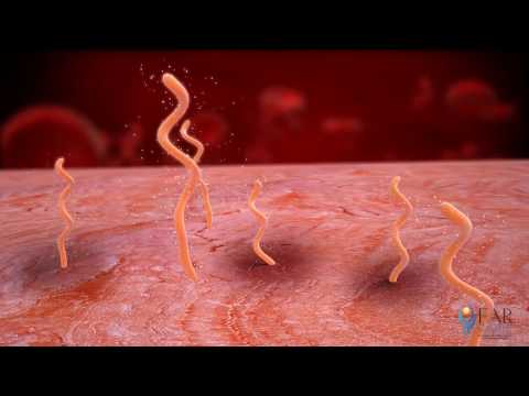 jó orvosság a pinwormok ellen széles mérőszalag
