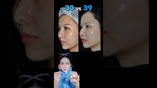 รีวิวโปรแกรม #thermage 7 ปี #erkerkxiskycenter #erkerkbeauty #wwwerkerkcom