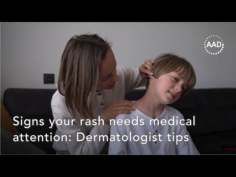 Signs your rash needs medical attention: Dermatologist tips