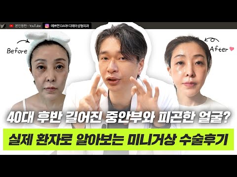 내 생애 가장 예뻤던 시절로? 미니거상을 통해 돌아가 보세요!ㅣ디에이성형외과
