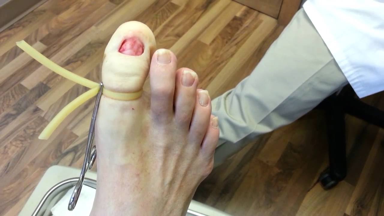 Ingrown nail treatment and surgery PNA | South West Podiatry