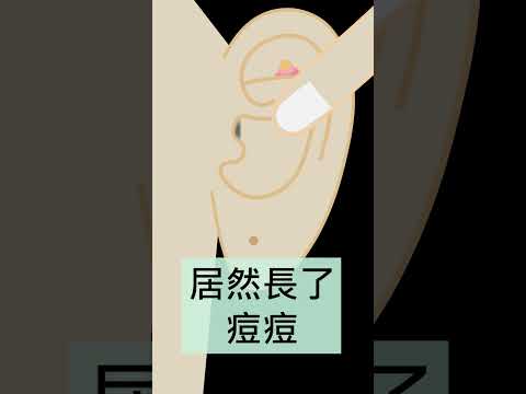 耳朵長痘痘 面相
