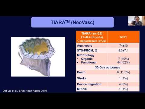 Transcatheter Mitral and Tricuspid Valve Replacement