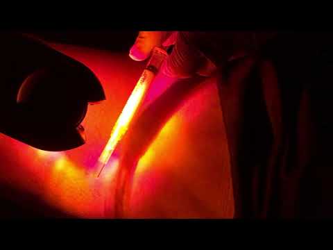 Escleroterapia en Cali - Dra. Silvia Perafán dermatólogo en Cali